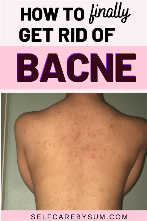 How To Clear Back Acne Finally Sbs In 2021 Back Acne Treatment Acne