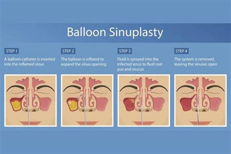 Balloon Sinuplasty A Minimally Invasive Procedure To Treat Chronic