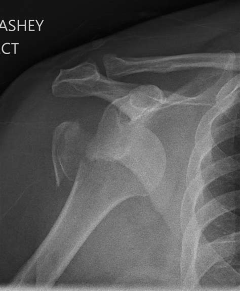 Shoulder And Elbow Surgery Proximal Humerus Fracture Dislocation Do