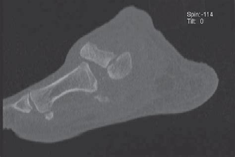 Ct Scan Of The Left Foot Download Scientific Diagram