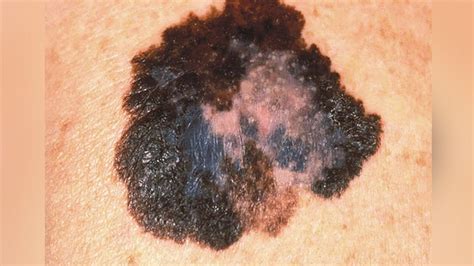 Researchers Find Clues On How Melanoma Resists Effective Treatments