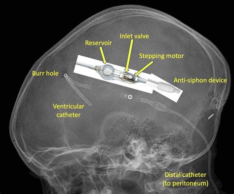 Cerebrospinal Shunts Questions And Answers In MRI