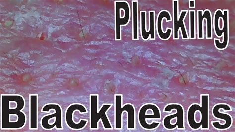 Plucking Blackheads Close Up Part3 【pluckingpluckingplucking