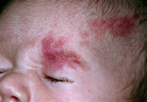 Port Wine Stain On Babys Forehead Photograph By Dr P Marazziscience