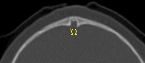 The Omega Sign On Axial Ct Scan The Prematurely Fused Metopic Suture