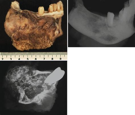 Osteosarcoma Of The Jaws Musculoskeletal Key
