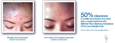 Silkpeel Is Amazing At Treating Acne The Revolutionary Process Not