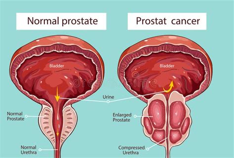Hypertrophie Prostatique Illustration De Vecteur Illustration Du Prostate 92093348
