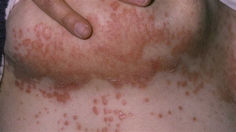 Rashes Between Breasts Pictures Cancer Diabetes And Pregnancy