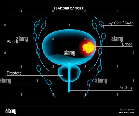 Bladder Cancer Stages Illustration Stock Photo Alamy