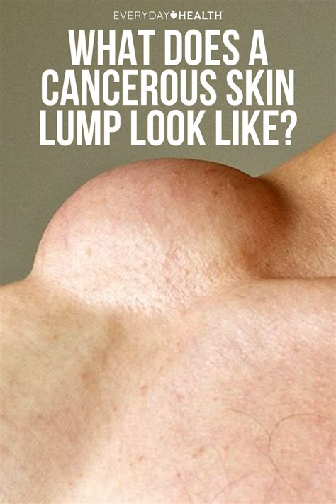 what does a cancerous skin lump look like skin epidermoid cyst psoriasis biologics