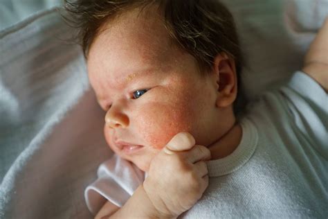 14 Common Rashes In Babies And Kids Causes And Treatment