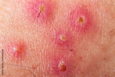 Wound Infection On The Skin Skin Lesions Impetigo Ecthyma Pressure