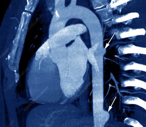 Aortic Aneurysms Ct Scan Stock Image M1750550 Science Photo Library