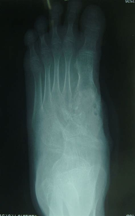 Aneurysmal Bone Cyst Of Medial Cuneiform And A Novel Surgical Technique