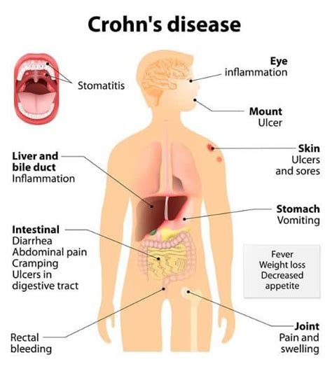 Crohn S Disease London Gastroenterology Centre