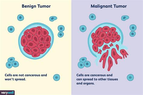 Unterschiede Zwischen Einem Bösartigen Und Einem Gutartigen Tumor