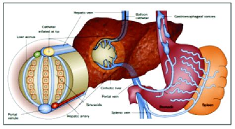 Measuring The Portal Pressure In The Normal And Cirrhotic 3 Liver