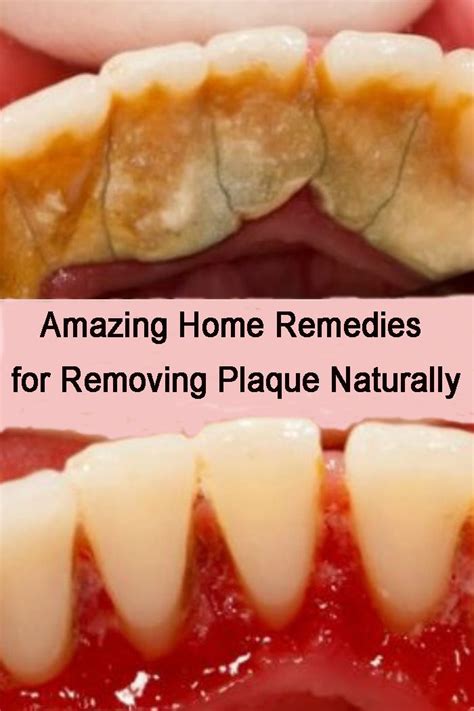Amazing Home Remedies For Removing Plaque Naturally Dental Health