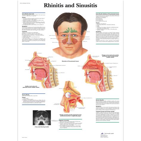 Understanding Sinusitis Chart Ph