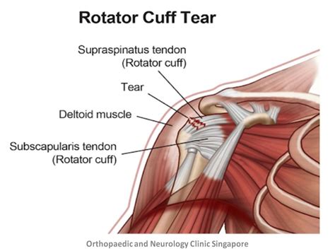 Rotator Cuff Injury Causes
