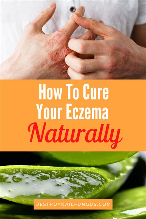 How To Treat Eczema With Aloe Vera The Ultimate Guide