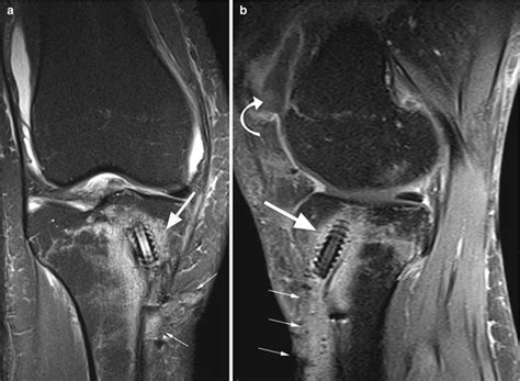 Anterior Cruciate Ligament Acl Radiology Key