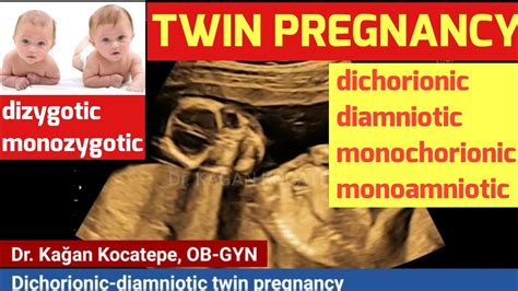 Twin Pregnancy Typesdichorionic Diamnioticmonochorionic Diamniotic