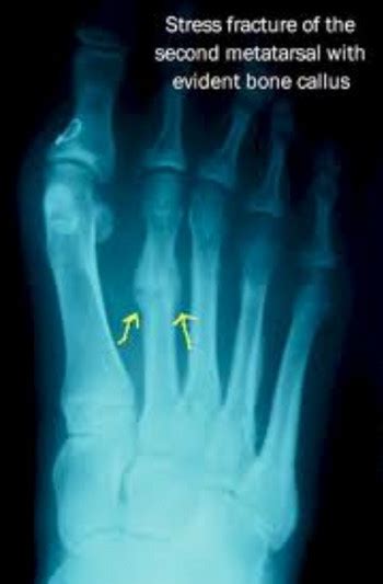 X Ray Showing Stress Fracture Of The Second Metatarsal Current Health Advice Health Blog