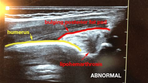 Arthrocentesis Of The Elbow Joint Internet Book Of Msk Ultrasound