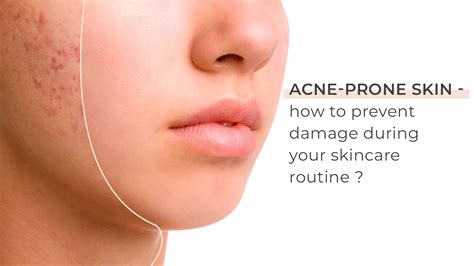 Acne Prone Skin How To Prevent Damage During Your Skincare Routine