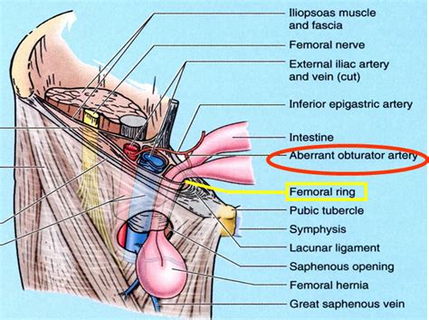 Femoral Hernia Anatomy Female