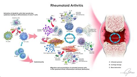 Rheumatoid Arthritis Infographic Geras Healthcare Productions