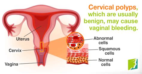 If you have changes in the cells of your cervix abnormal vaginal bleeding: Vaginal Bleeding during Postmenopause | Menopause Now