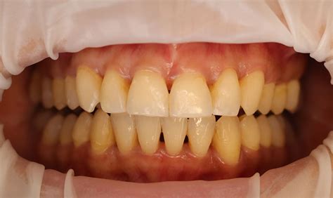 Porcelain Veneers Mississauga Smiles Dentistry