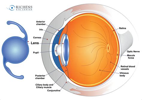 Richens Eye Center Offers A Closer Look At Cataract Surgery And Intraocular Lens Implant Options