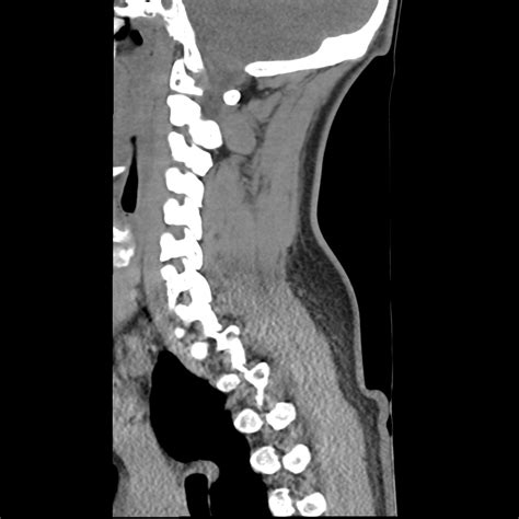 Filenormal Trauma Chest Pelvis And Spine Imaging Radiopaedia 31535