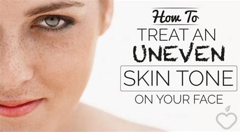 How To Treat An Uneven Skin Tone On Your Face Uneven Skin Uneven