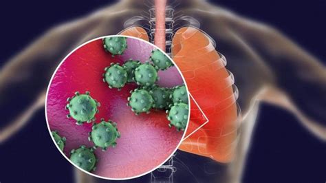 Coronavirus Qu Le Hace Esta Enfermedad Al Cuerpo Y Qu Pas Con Los