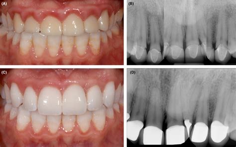 A Intraoral Preoperative Condition Of A Patient With Full Coverage
