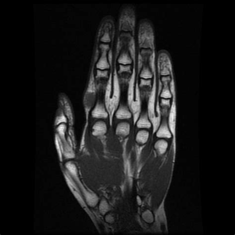 Tenosynovial Giant Cell Tumor Index Finger Image