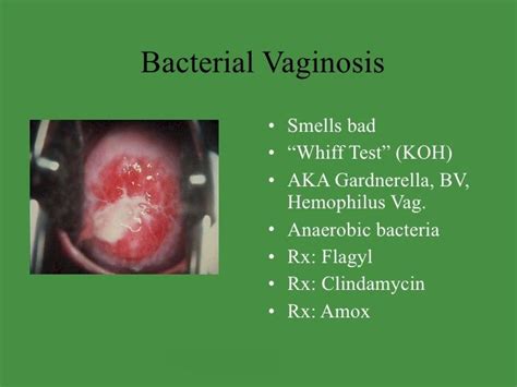 114 Best Bacterial Vaginosis Images On Pinterest Bacterial Infection