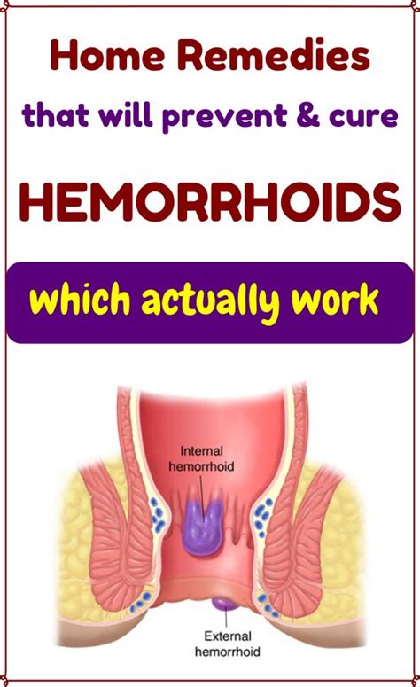 12 Simple Home Remedies To Ease Hemorrhoid Pain Healthy Clever