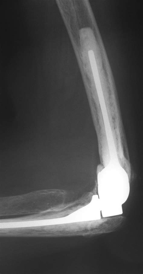 Gsb Iii Total Elbow Replacement In Rheumatoid Arthritis Bone And Joint