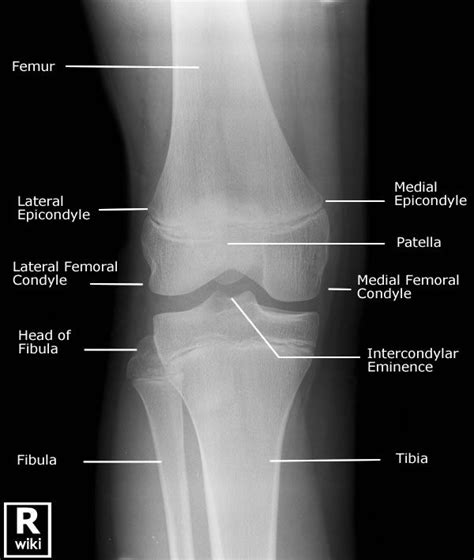 Lateral Knee X Ray Anatomy