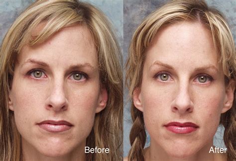 Coronal lifts are ideal for individuals with. Botox Case Studies Beverly Hills | Dysport Beverly Hills ...