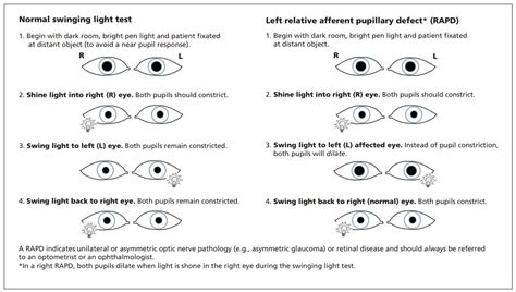 Instructions On How To Perform The Swinging Light Test Grepmed