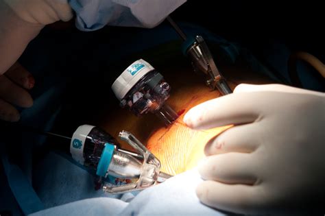 Laparoscopic Trocars Provide Access Points For Surgery Laparoscopic Md