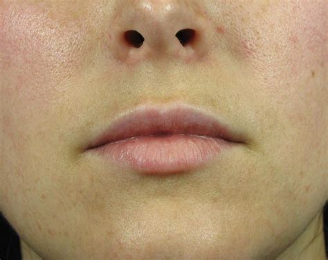 Teosyal Kiss For A Small Mouth Advanced Rejuvenation Medical Spa