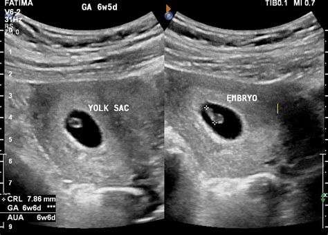 Early Pregnancy Ultrasound